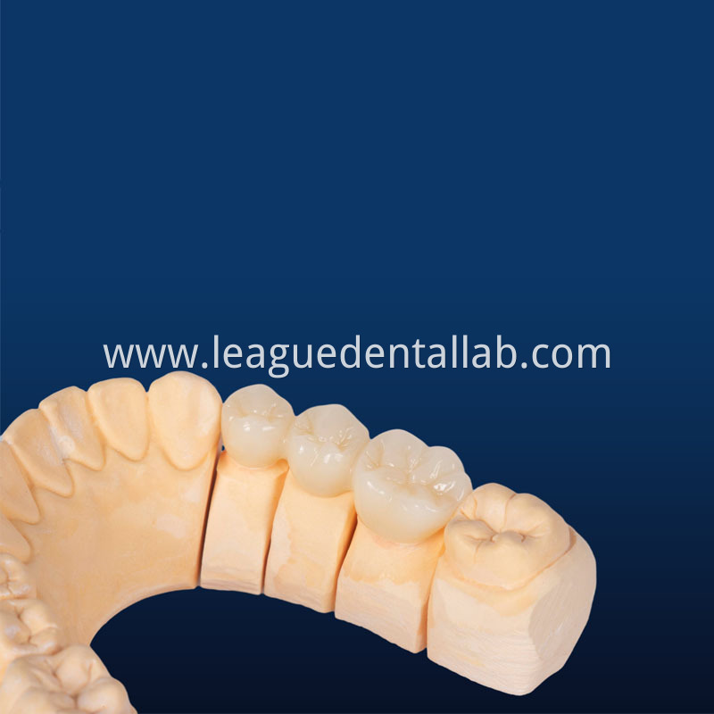 Full Zirconia crown,Full contour zirconia,Solid Zirconia,Zirconia,Monolithic Zirconia